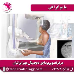 ماموگرافی 