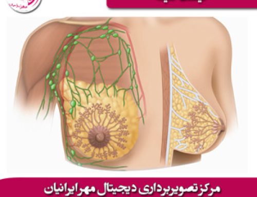 کیست سینه را چگونه می توان مهار کرد ؟