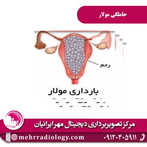 حاملگی مولار - سونوگرافی مهر ایرانیان