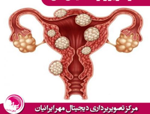 اندومتریوز و تشخیص آن