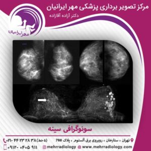 سونوگرافی سینه - سونوگرافی مهر ایرانیان