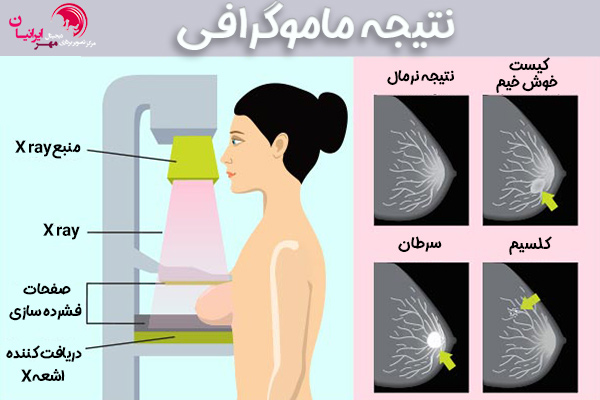 ماموگرافی + مهر ایرانیان