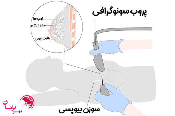 بیوپسی پستان - تصویربرداری مهر ایرانیان
