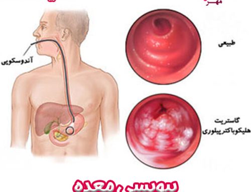 بیوپسی معده + تفسیر جواب آزمایش نمونه برداری