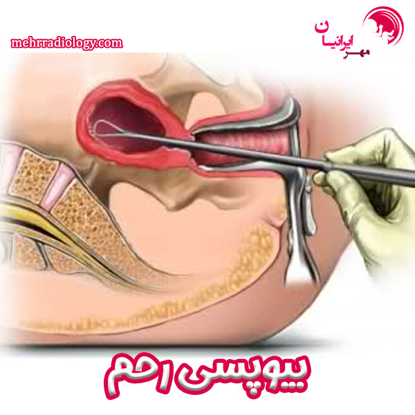 بیوپسی رحم