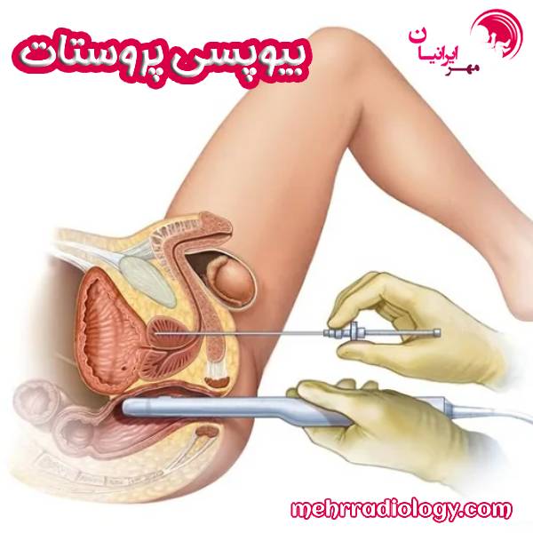 بیوپسی پروستات