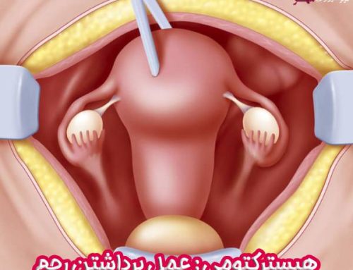 هیسترکتومی ؛ عملی برای برداشتن رحم