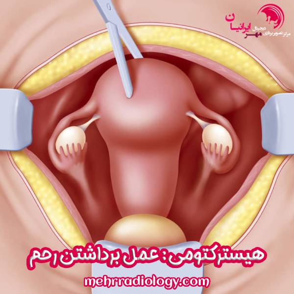 هیسترکتومی