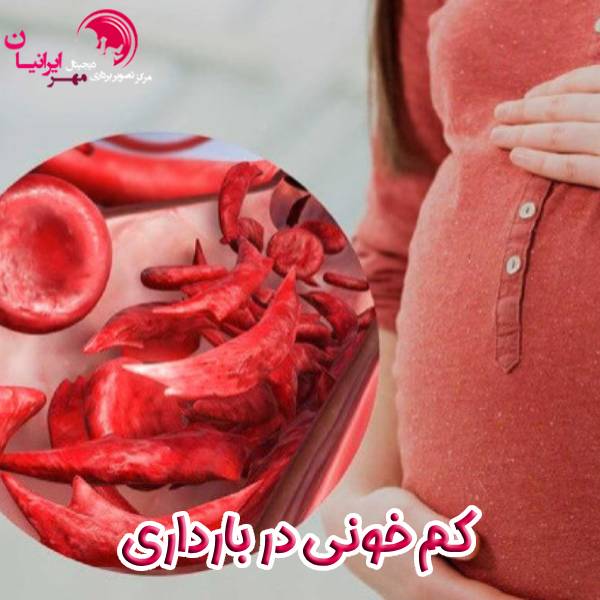 کم خونی در بارداری